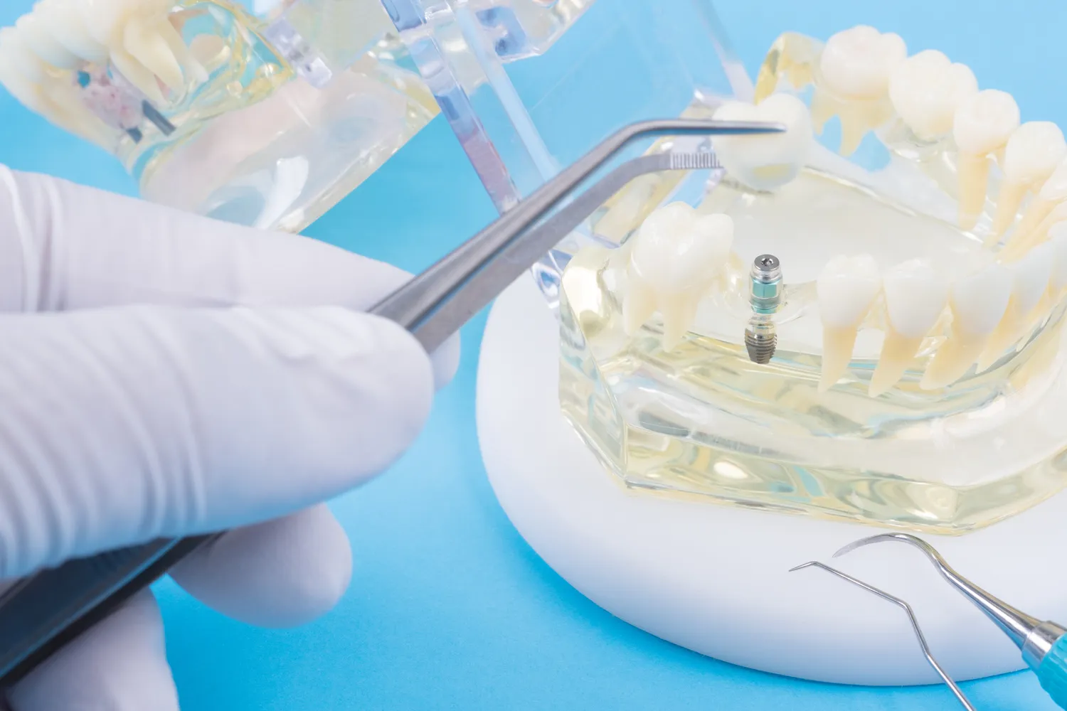 kiedy leczenie kanałowe objawy