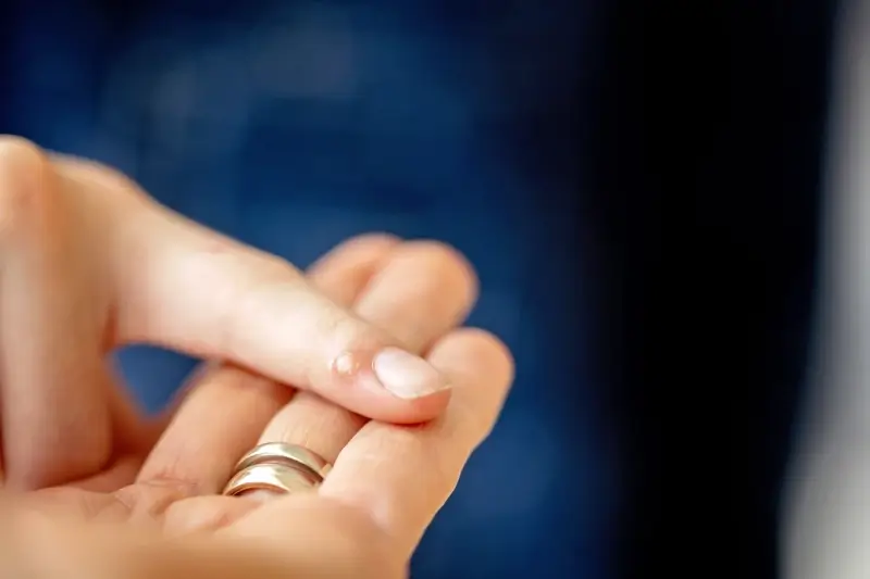 Jak długo trwa leczenie kurzajki?