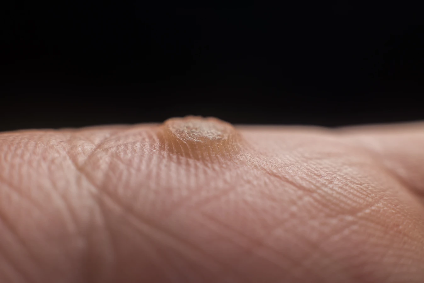 Jak odróżnić odcisk od kurzajki?